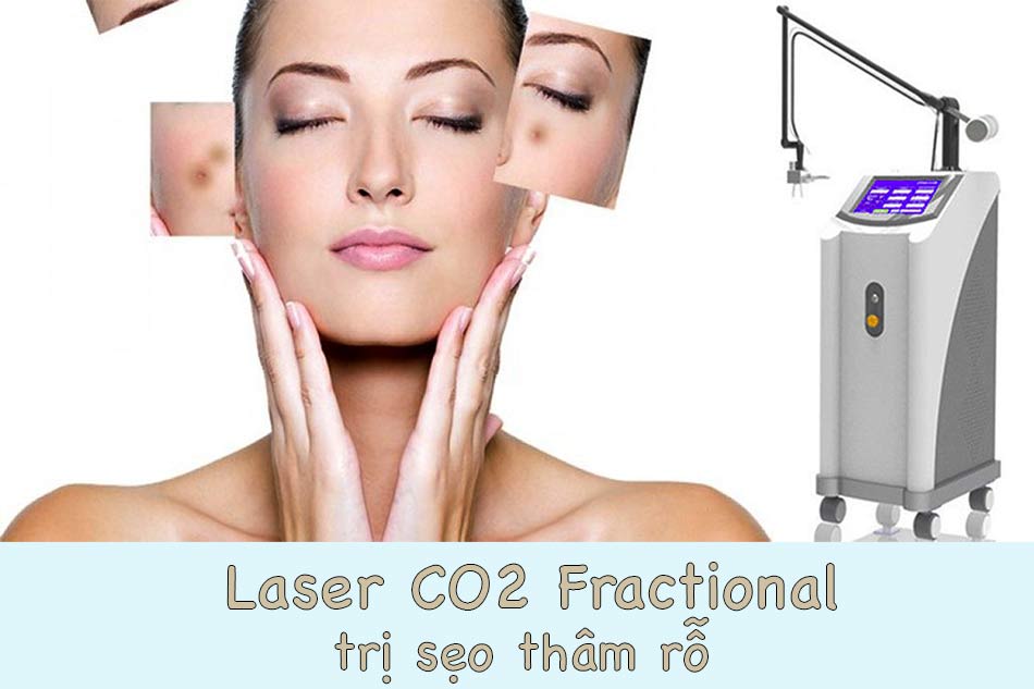 Phương pháp điều trị sẹo rỗ bằng Laser CO2 Fractional