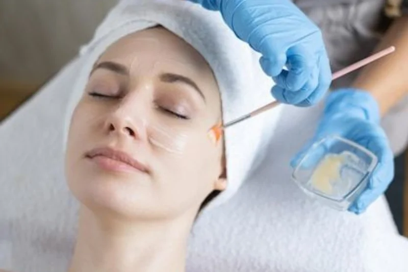 Peel da là phương pháp an toàn và hiệu quả trong việc điều trị nám 